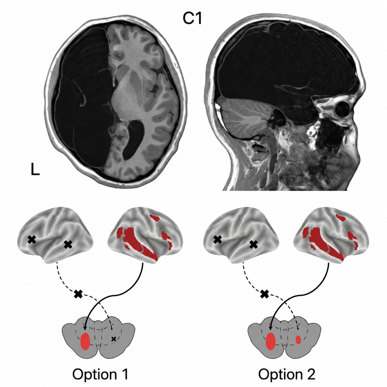 C1's brain anatomy and two possible patterns of cerebellar language organization